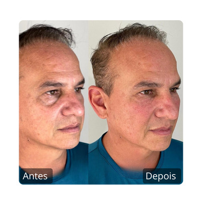 Botox - Harmonização Facil antes e depois (1)