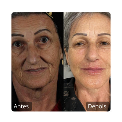 Botox - Harmonização Facil antes e depois (2)