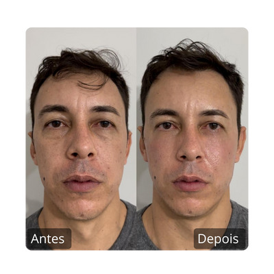 Botox - Harmonização Facil antes e depois (3)