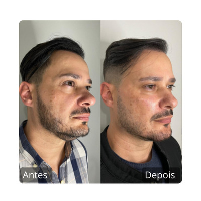 Botox - Harmonização Facil antes e depois (6)