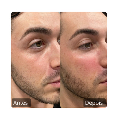 Botox - Harmonização Facil antes e depois (7)