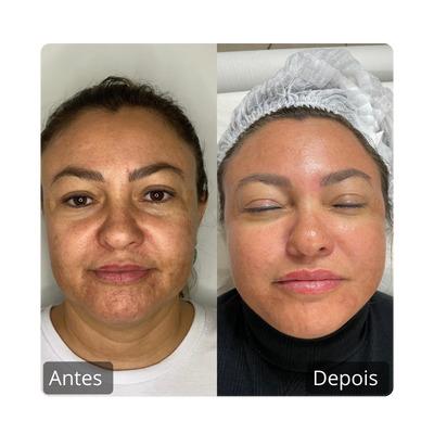 Botox - Harmonização Facil antes e depois