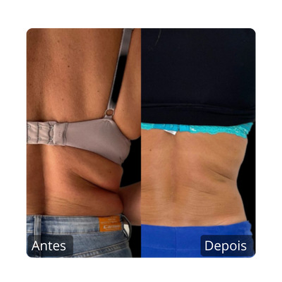 Emagrecimento e gordura lozalizada antes e depois culote (2)