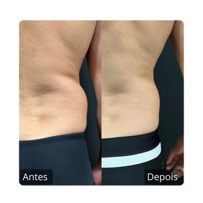 Emagrecimento e gordura lozalizada antes e depois culote