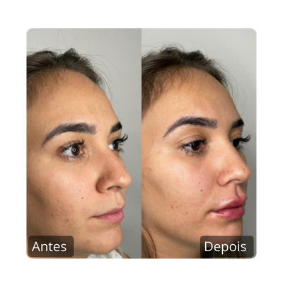 Preenchimento Labial antes e depois (10)