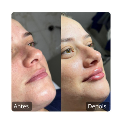 Preenchimento Labial antes e depois (11)