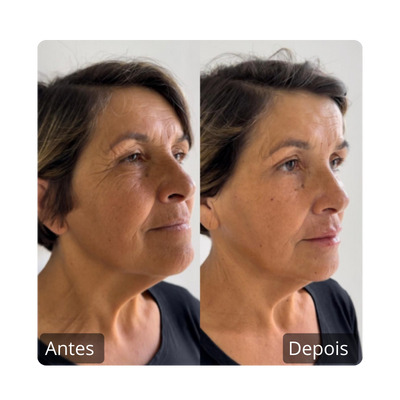 Preenchimento Labial antes e depois (15)