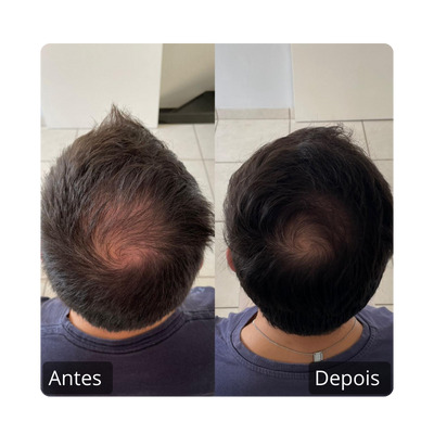 Queda Capilar Antes e Depois (1)