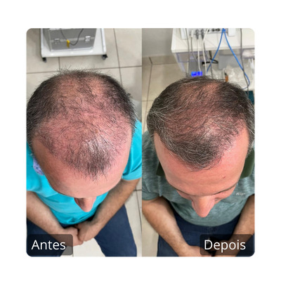 Queda Capilar Antes e Depois (2)