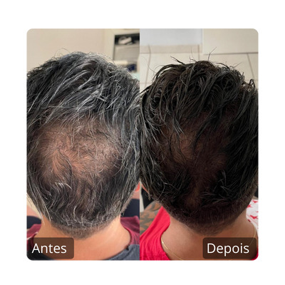 Queda Capilar Antes e Depois (3)