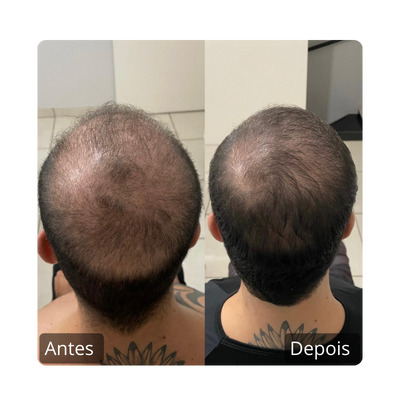 Queda Capilar Antes e Depois (4)