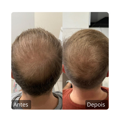 Queda Capilar Antes e Depois (5)