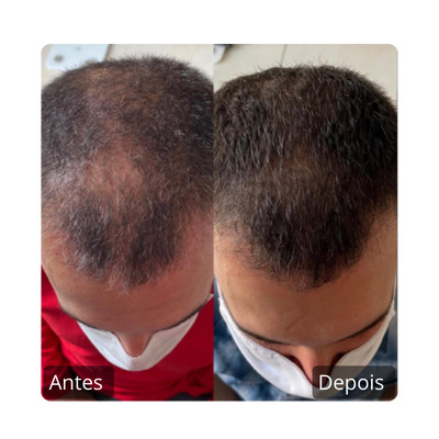 Queda Capilar Antes e Depois