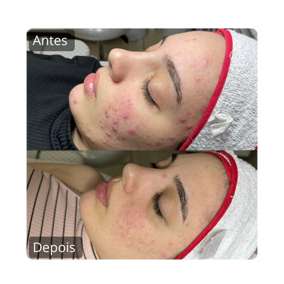 Tratamento para acne antes e depois