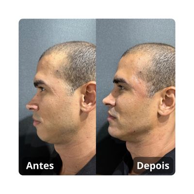 Antes e depois